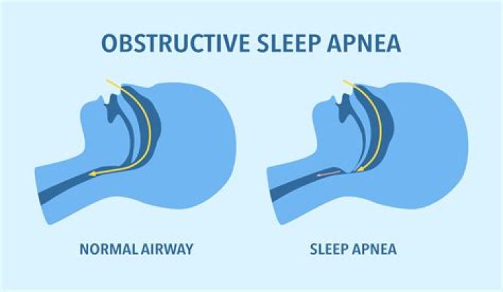 Are you deployable with sleep apnea?
