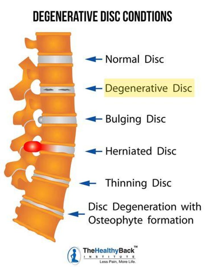 At what age does disc desiccation start?