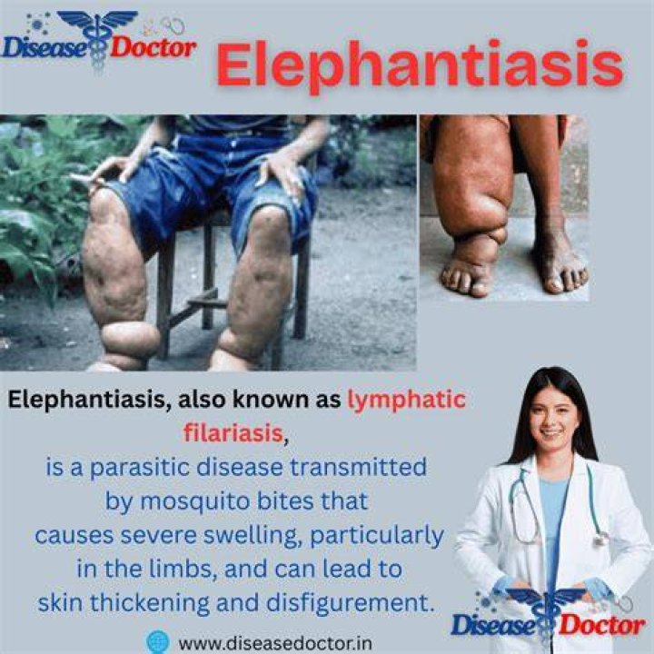 By whom elephantiasis spread?