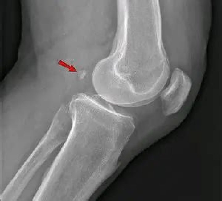 Can fabella cause pain?