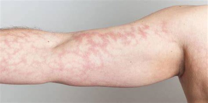 Can fever cause mottled skin?