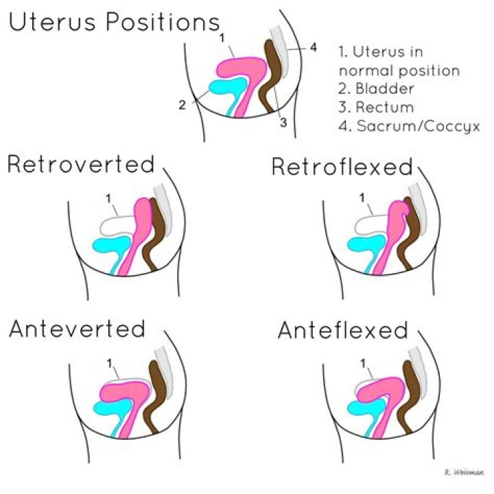 Can retroverted uterus cause back pain?