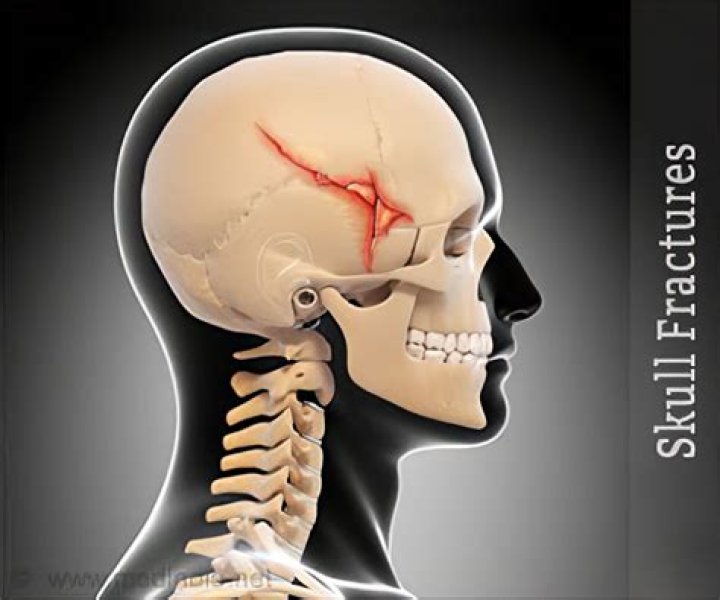 Can you bruise your skull?