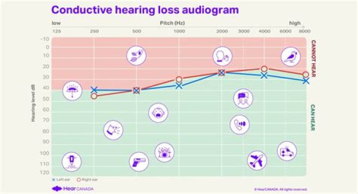 Can you cure conductive hearing loss?
