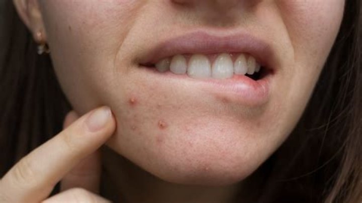 Do blind pimples always come to a head?