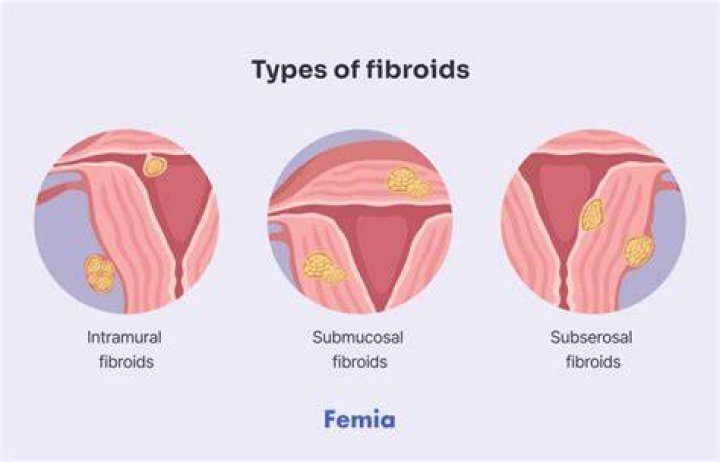 Do fibroids cause necrosis?