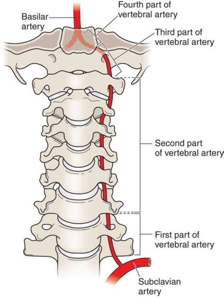 Do vertebral artery dissections heal?