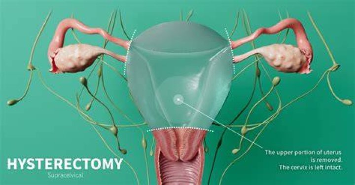 Does a hysterectomy make you postmenopausal?
