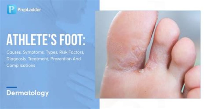 Does athlete's foot flare up?