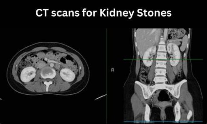 Does iv contrast obscure kidney stones?