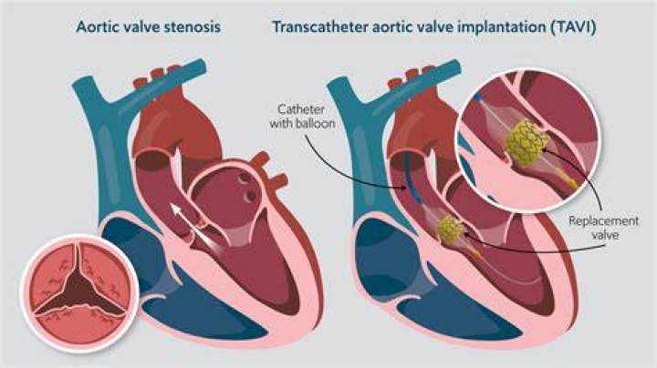 How is tavi performed?