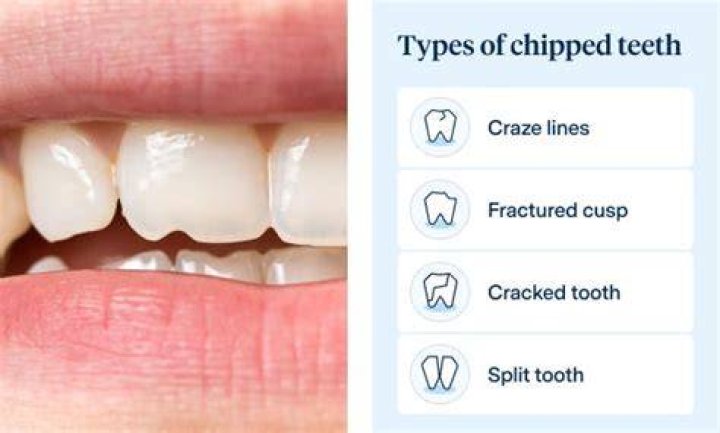 How serious is a chipped tooth?