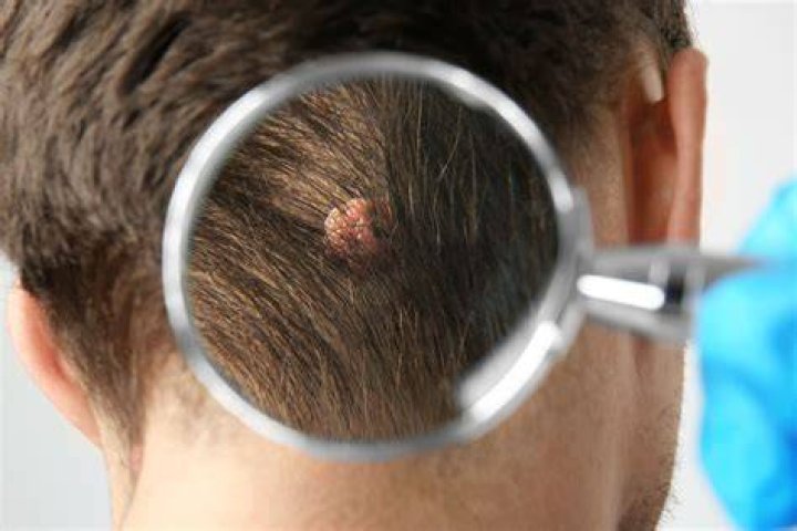 How to remove a mole off your head?