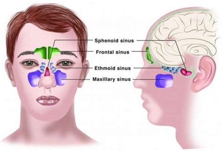 In eustachian catarrh meaning?