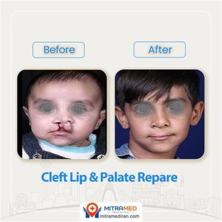 Is cleft palate surgery dangerous?