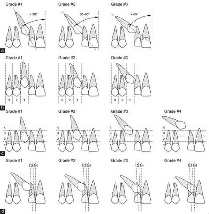 Should canines be longer than incisors?