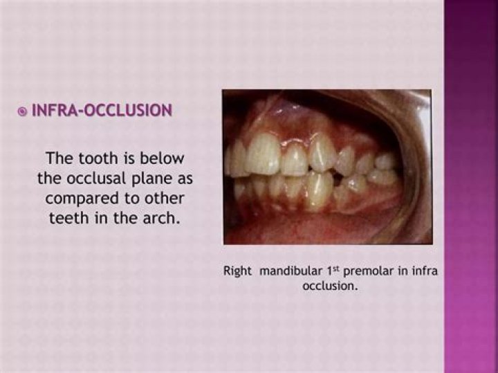 What is dental infraocclusion?
