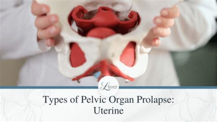 What is pelvic organ prolapse?