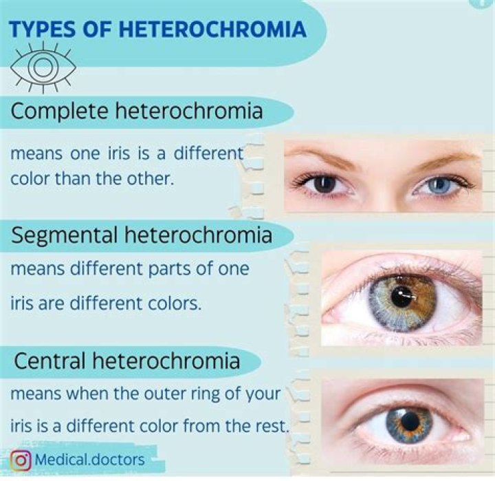 Where is the heterochromia located?
