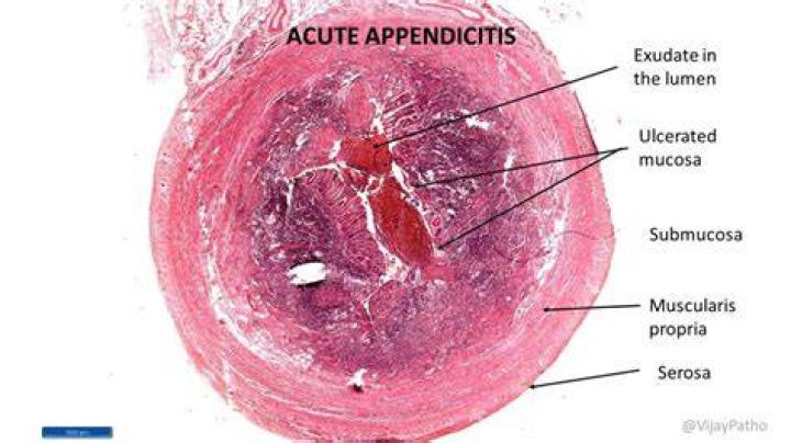 Where is the serositis located?