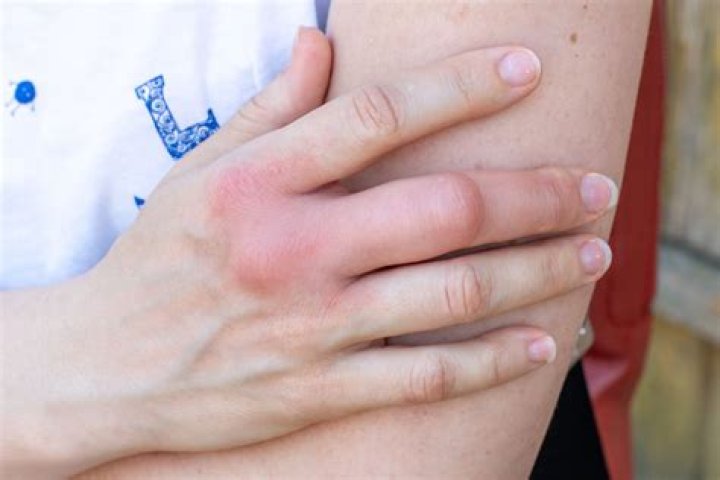 Why are my hands swollen and red?
