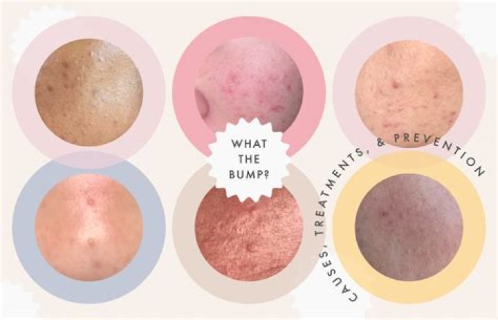 Why are my pores so noticeable?