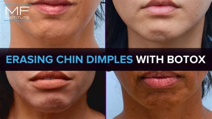 Why is my chin so dimply?