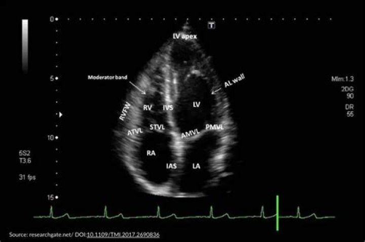 Will echocardiogram show artery blockage?
